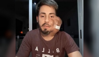 Tiene cáncer y el IOMA le niega la prótesis: “No me quiero morir”