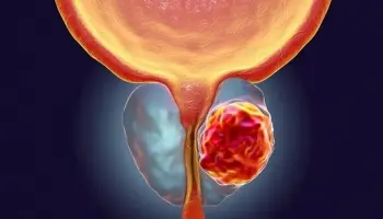 Cáncer de próstata, un enemigo silencioso