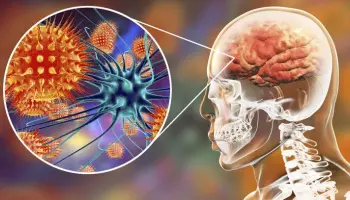 Prevención de la meningitis: "Uno de cada cinco pacientes puede quedar con secuelas permanentes"