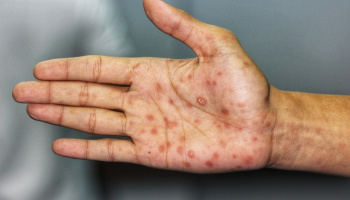 "En Argentina los casos de sífilis aumentaron aproximadamente el 40 por ciento"