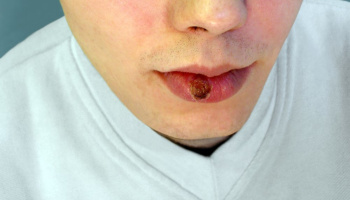 “Hoy convivir con el VIH es posible, pero preocupa el aumento de casos de sífilis en el país”