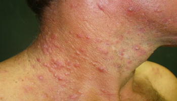 El Colegio de Médicos bonaerense advierte: “La sífilis volvió con fuerza y es mortal si no se trata”